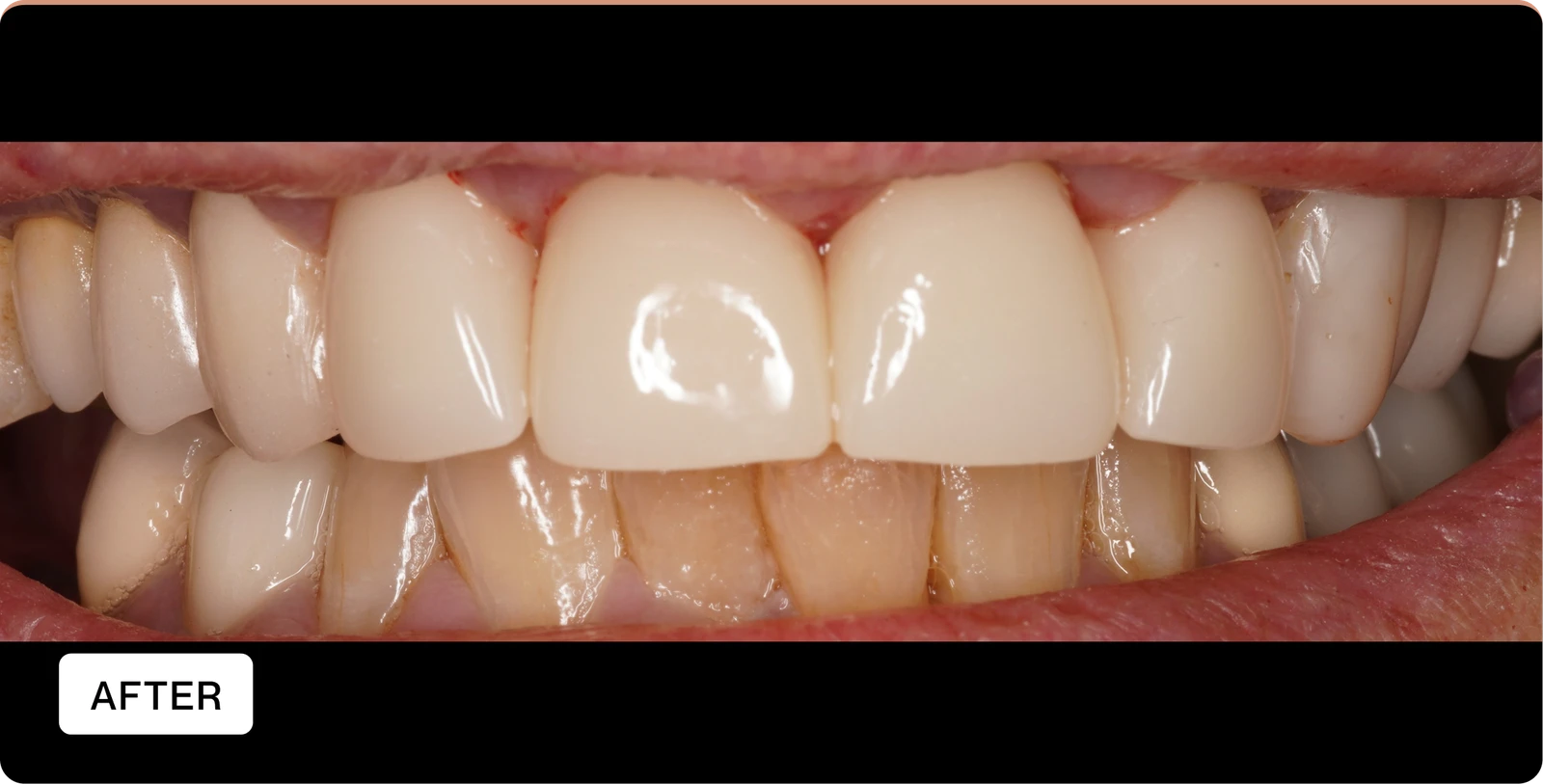 After — Procedure: 6 Crowns